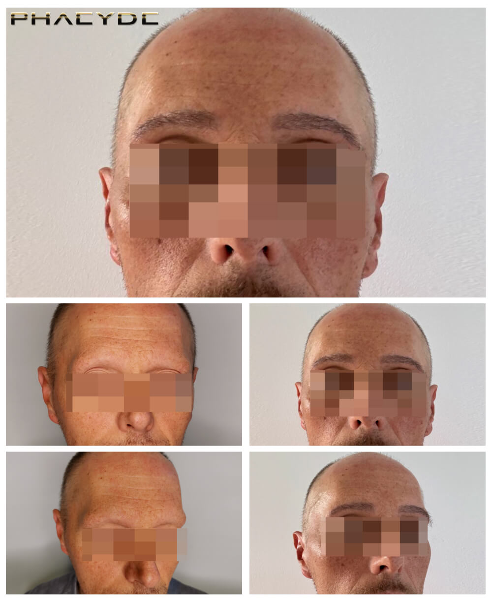 Трансплантация бровей