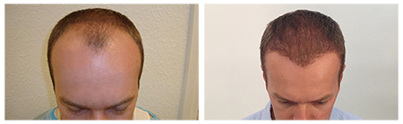 PHAEYDE Clinic Hair Transplant Results